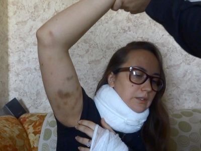 Травмы, полученные при задержании. Фото: Сергей Попов, Каспаров.Ru Травмы, полученные при задержании. Фото: Сергей Попов, Каспаров.Ru