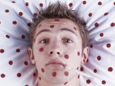 Эпидемия кори. Фото: infonews.zp.ua Эпидемия кори. Фото: infonews.zp.ua