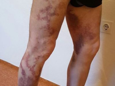 Следы пыток. Фото: infochechen.com Следы пыток. Фото: infochechen.com